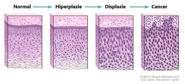 Modificări tisulare ce duc la cancer